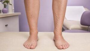 Side-by-side lower legs showing a small spider-vein cluster and a mild raised varicose vein.